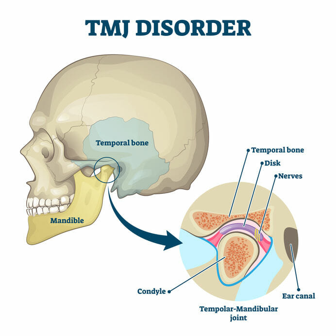 TMJ jaw disorder, TMJ jaw problems