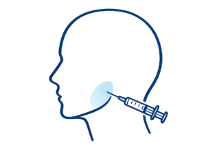 Illustration showing a Botox injection into the jaw muscle for TMJ treatment