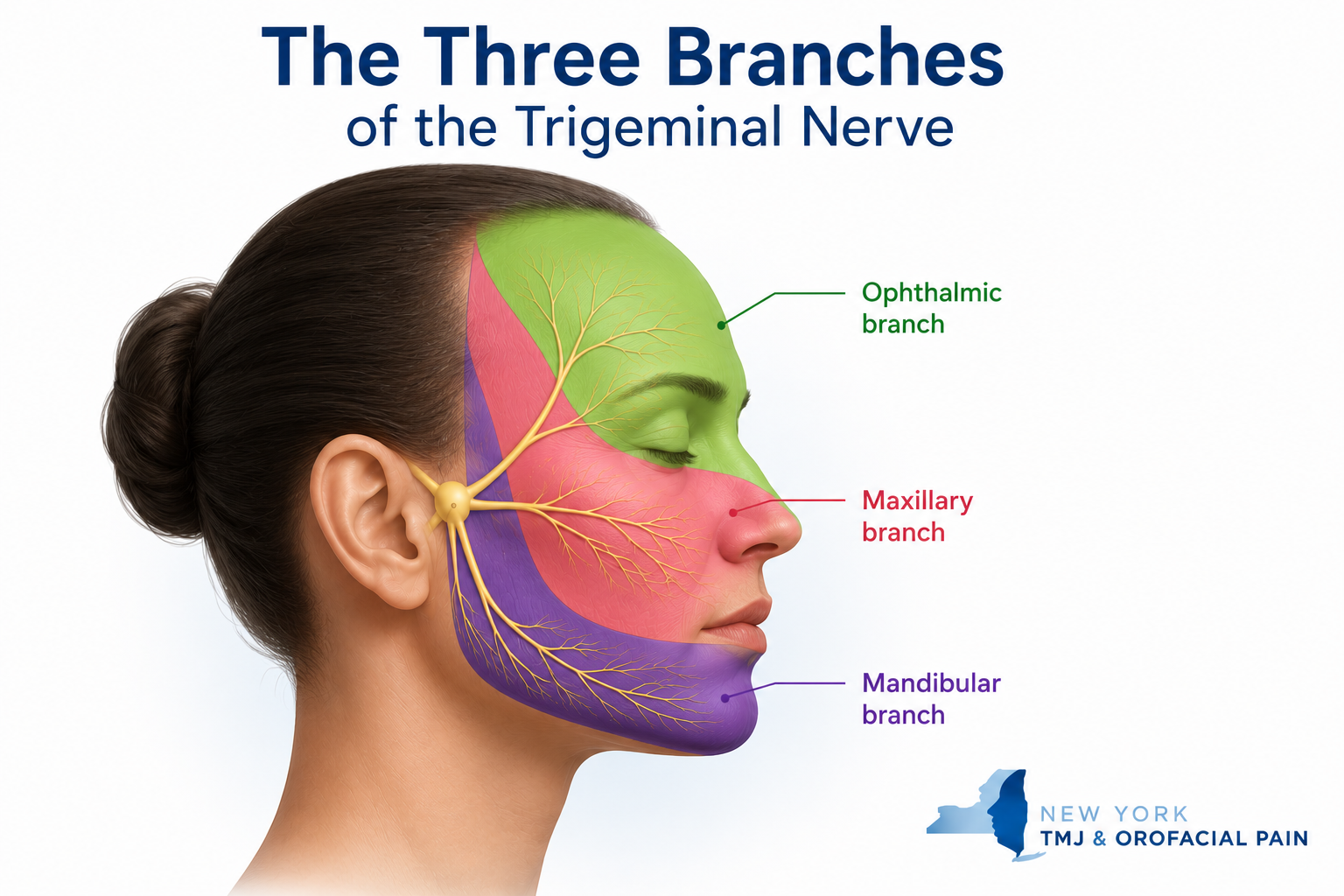 Illustration showing the three branches of the trigeminal nerve: ophthalmic, maxillary, and mandibular