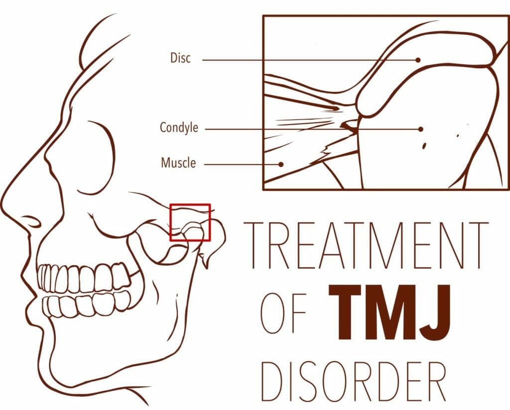 TMJ disorder vector
