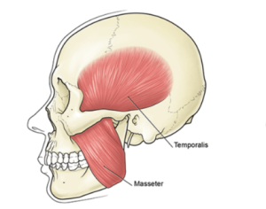 Anatomical diagram showing the masseter and temporalis muscles on the side of the skull—key sources of referred tooth and jaw pain.