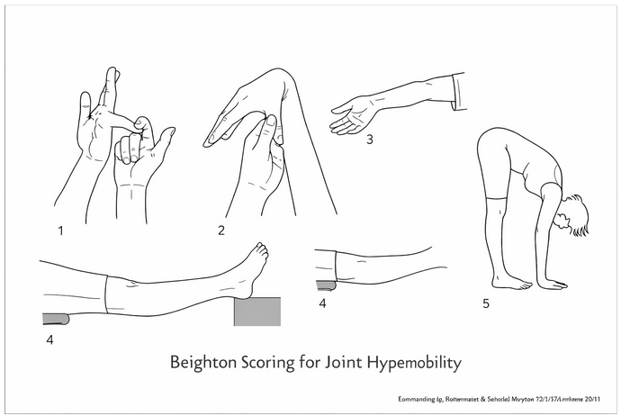 Beighton score joint hypermobility clinical assessment diagram
