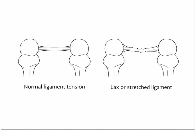 lax ligament vs normal tension joint instability diagram