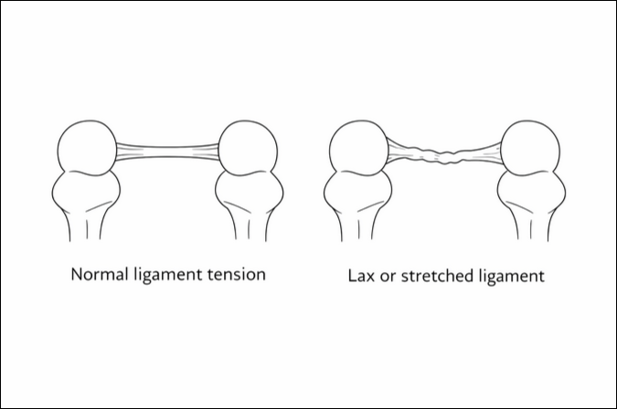 lax ligament vs normal tension joint instability diagram