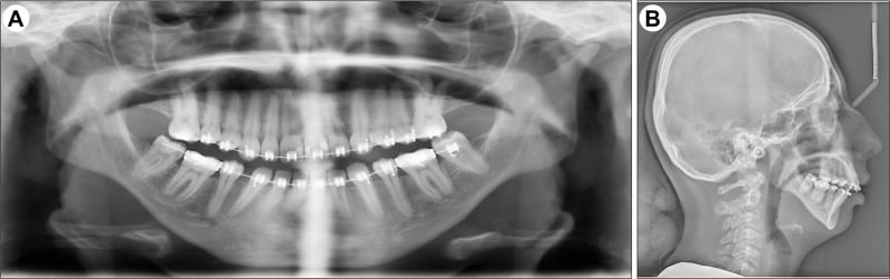 Panoramic and lateral cephalometric radiographs showing idiopathic condylar resorption affecting the temporomandibular joints.